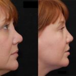 Rhinoplasty (Nose Reshaping) Before and After Photos in Cincinnati, OH, Patient 6150