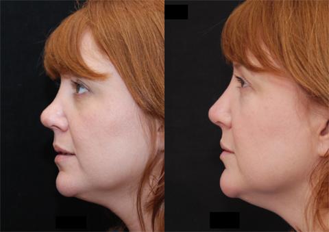 Rhinoplasty (Nose Reshaping) Before and After Photos in Cincinnati, OH, Patient 6150
