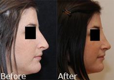 Rhinoplasty (Nose Reshaping) Before and After Photos in Cincinnati, OH, Patient 6155