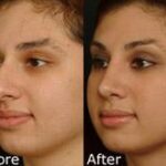 Rhinoplasty (Nose Reshaping) Before and After Photos in Cincinnati, OH, Patient 6158