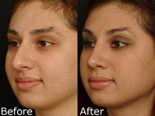Rhinoplasty (Nose Reshaping) Before and After Photos in Cincinnati, OH, Patient 6158