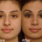Rhinoplasty (Nose Reshaping) Before and After Photos in Cincinnati, OH, Patient 6158