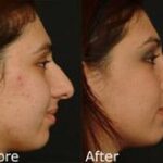 Rhinoplasty (Nose Reshaping) Before and After Photos in Cincinnati, OH, Patient 6158