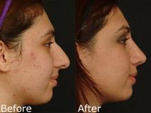 Rhinoplasty (Nose Reshaping) Before and After Photos in Cincinnati, OH, Patient 6158