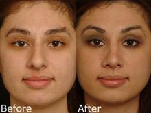 Rhinoplasty (Nose Reshaping) Before and After Photos in Cincinnati, OH, Patient 6158