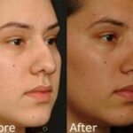 Rhinoplasty (Nose Reshaping) Before and After Photos in Cincinnati, OH, Patient 6165