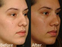 Rhinoplasty (Nose Reshaping) Before and After Photos in Cincinnati, OH, Patient 6165