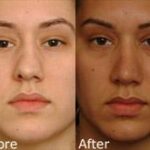 Rhinoplasty (Nose Reshaping) Before and After Photos in Cincinnati, OH, Patient 6165