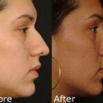 Rhinoplasty (Nose Reshaping) Before and After Photos in Cincinnati, OH, Patient 6165