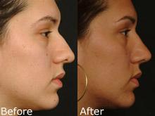 Rhinoplasty (Nose Reshaping) Before and After Photos in Cincinnati, OH, Patient 6165