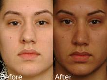 Rhinoplasty (Nose Reshaping) Before and After Photos in Cincinnati, OH, Patient 6165