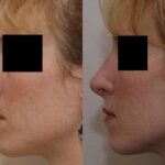 Rhinoplasty (Nose Reshaping) Before and After Photos in Cincinnati, OH, Patient 6175