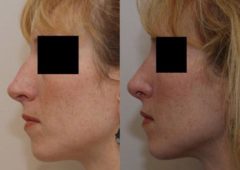 Rhinoplasty (Nose Reshaping) Before and After Photos in Cincinnati, OH, Patient 6175