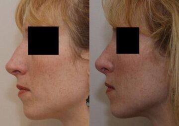 Rhinoplasty (Nose Reshaping) Before and After Photos in Cincinnati, OH, Patient 6175