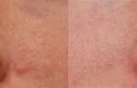 Rhinoplasty (Nose Reshaping) Before and After Photos in Cincinnati, OH, Patient 6178