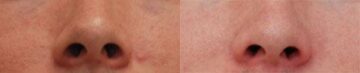 Rhinoplasty (Nose Reshaping) Before and After Photos in Cincinnati, OH, Patient 6178