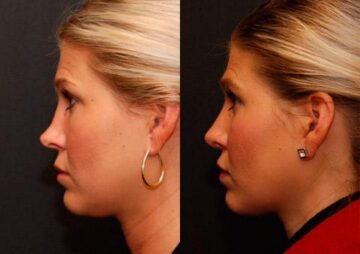 Rhinoplasty (Nose Reshaping) Before and After Photos in Cincinnati, OH, Patient 6189