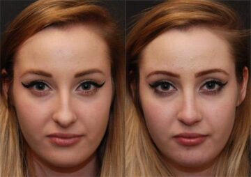 Rhinoplasty (Nose Reshaping) Before and After Photos in Cincinnati, OH, Patient 6199