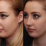 Rhinoplasty (Nose Reshaping) Before and After Photos in Cincinnati, OH, Patient 6199
