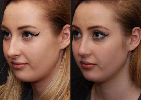 Rhinoplasty (Nose Reshaping) Before and After Photos in Cincinnati, OH, Patient 6199