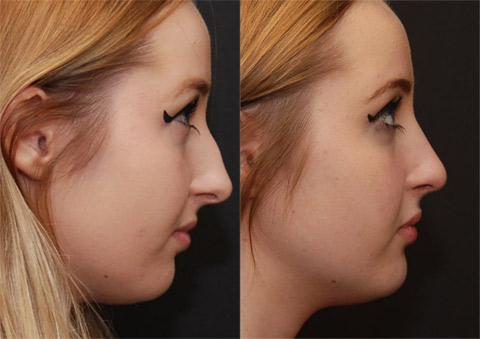Rhinoplasty (Nose Reshaping) Before and After Photos in Cincinnati, OH, Patient 6199
