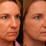 Rhinoplasty (Nose Reshaping) Before and After Photos in Cincinnati, OH, Patient 6206