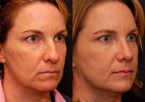 Rhinoplasty (Nose Reshaping) Before and After Photos in Cincinnati, OH, Patient 6206