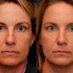Rhinoplasty (Nose Reshaping) Before and After Photos in Cincinnati, OH, Patient 6206