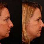 Rhinoplasty (Nose Reshaping) Before and After Photos in Cincinnati, OH, Patient 6206