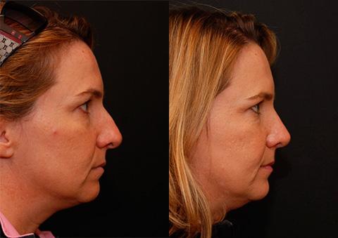 Rhinoplasty (Nose Reshaping) Before and After Photos in Cincinnati, OH, Patient 6206