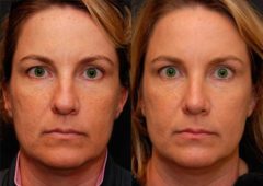 Rhinoplasty (Nose Reshaping) Before and After Photos in Cincinnati, OH, Patient 6206