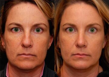 Rhinoplasty (Nose Reshaping) Before and After Photos in Cincinnati, OH, Patient 6206