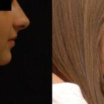 Rhinoplasty (Nose Reshaping) Before and After Photos in Cincinnati, OH, Patient 6213