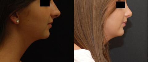 Rhinoplasty (Nose Reshaping) Before and After Photos in Cincinnati, OH, Patient 6213