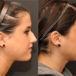 Rhinoplasty (Nose Reshaping) Before and After Photos in Cincinnati, OH, Patient 6216