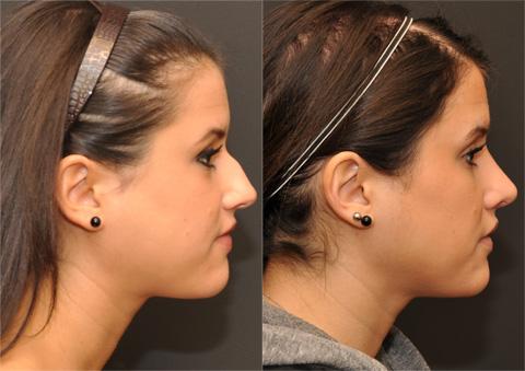 Rhinoplasty (Nose Reshaping) Before and After Photos in Cincinnati, OH