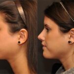 Rhinoplasty (Nose Reshaping) Before and After Photos in Cincinnati, OH, Patient 6216