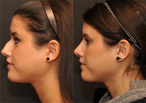 Rhinoplasty (Nose Reshaping) Before and After Photos in Cincinnati, OH, Patient 6216