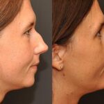 Rhinoplasty (Nose Reshaping) Before and After Photos in Cincinnati, OH, Patient 6221