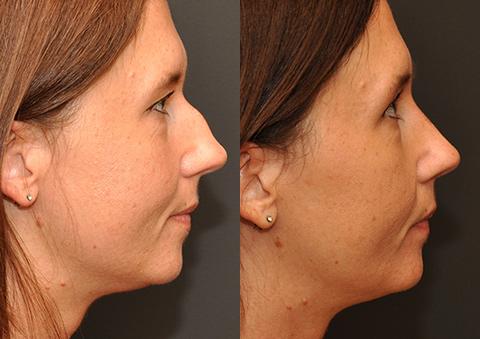 Rhinoplasty (Nose Reshaping) Before and After Photos in Cincinnati, OH, Patient 6221