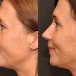 Rhinoplasty (Nose Reshaping) Before and After Photos in Cincinnati, OH, Patient 6221