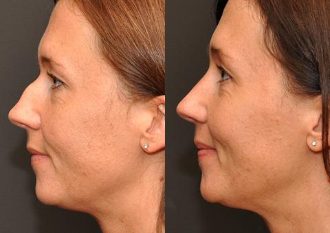 Rhinoplasty (Nose Reshaping) Before and After Photos in Cincinnati, OH, Patient 6221