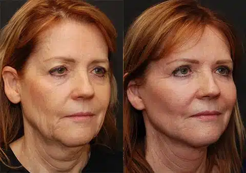 Minilift / Facelift Before and After Photos in Cincinnati, OH, Patient 5951