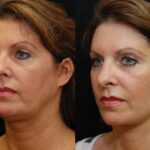 Minilift / Facelift Before and After Photos in Cincinnati, OH, Patient 5958