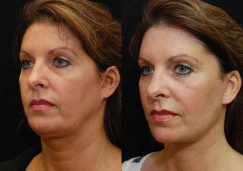 Minilift / Facelift Before and After Photos in Cincinnati, OH, Patient 5958