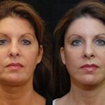 Minilift / Facelift Before and After Photos in Cincinnati, OH, Patient 5958