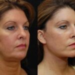 Minilift / Facelift Before and After Photos in Cincinnati, OH, Patient 5958