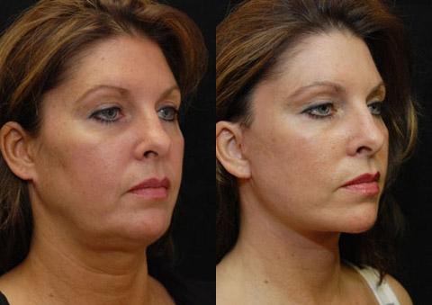 Minilift / Facelift Before and After Photos in Cincinnati, OH, Patient 5958