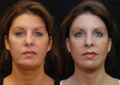 Minilift / Facelift Before and After Photos in Cincinnati, OH, Patient 5958