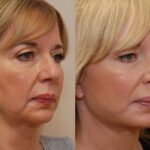 Minilift / Facelift Before and After Photos in Cincinnati, OH, Patient 5965